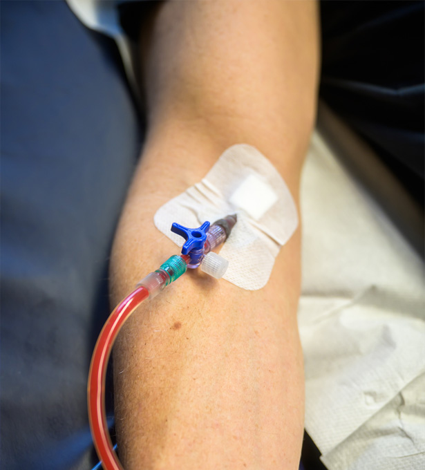Infusionsschlauch am Arm einer Person